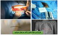 خارج کردن میخ 5 سانتیمتری از قلب  پسرجوان سبزواری